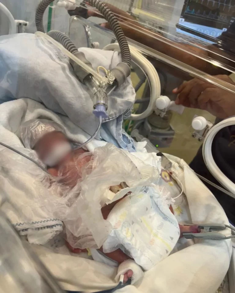 Bebê prematuro de 25 semanas é salvo em parto histórico no Materno Infantil de Cacoal